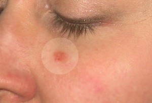 skin-cancer-big1